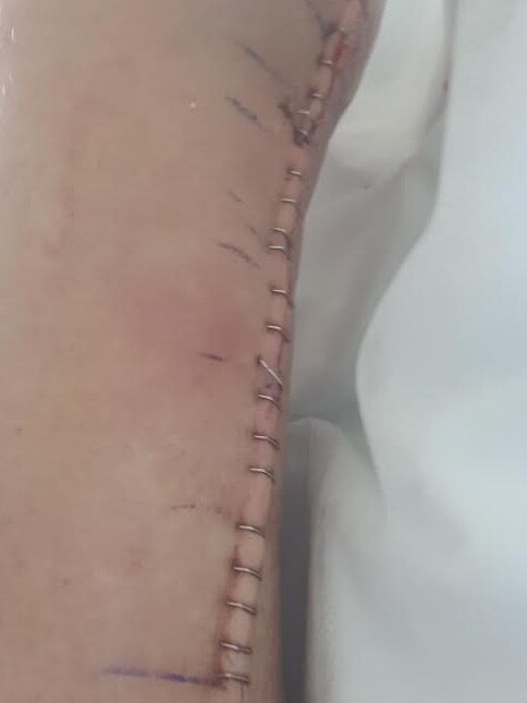 Julia Kent’s leg following surgery. Picture: Supplied