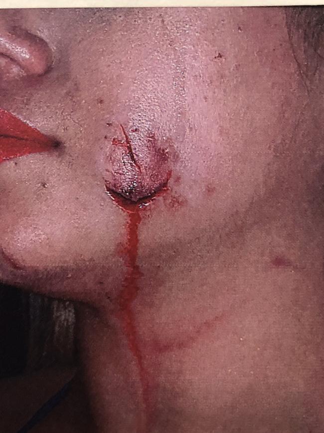 The victim’s bite wound, which required surgery.