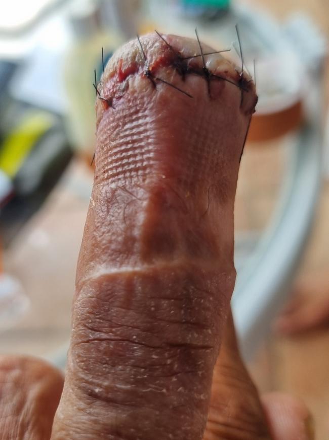 The infection forced Mark to have fingers and toes amputated. Picture: Supplied.