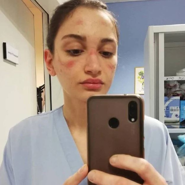 Italian nurse Alessia Bonari shared how PPE had left her bruised and injured. Picture: Instagram/Alessiabonari