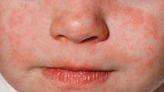 A child with measles. Picture: NSW Health