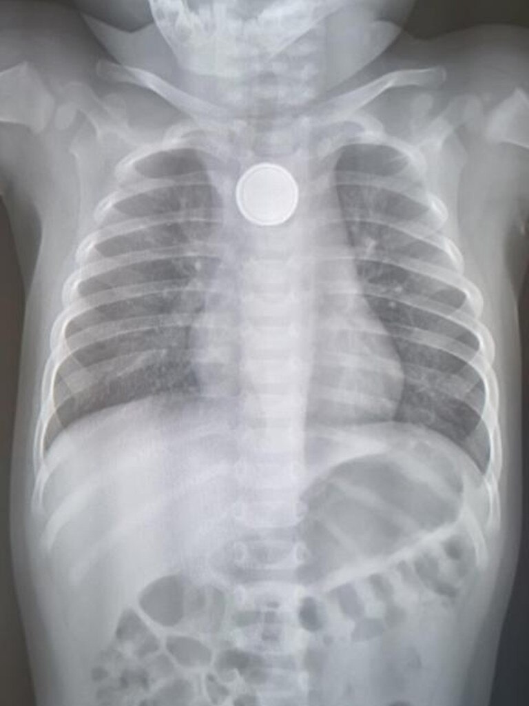 An X-ray showing the battery in Amity’s throat.