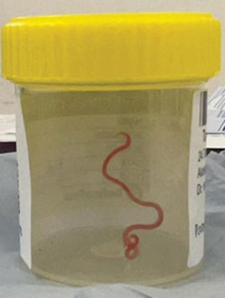 Doctors discovered a worm, usually found in python snakes, ‘alive and wriggling’ in her brain. Picture: CDCP