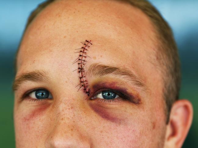 South Sydney Rabbitohs Jason Clark shows off his stitches he received from last weekend's round. Picture. Phil Hillyard