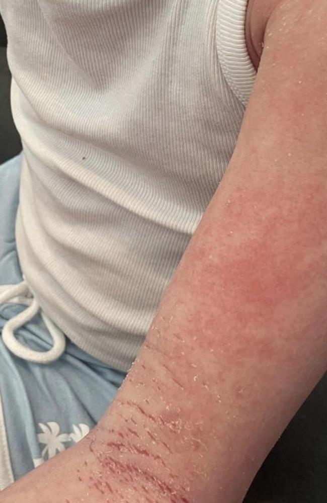 A serious case of eczema. Picture: supplied