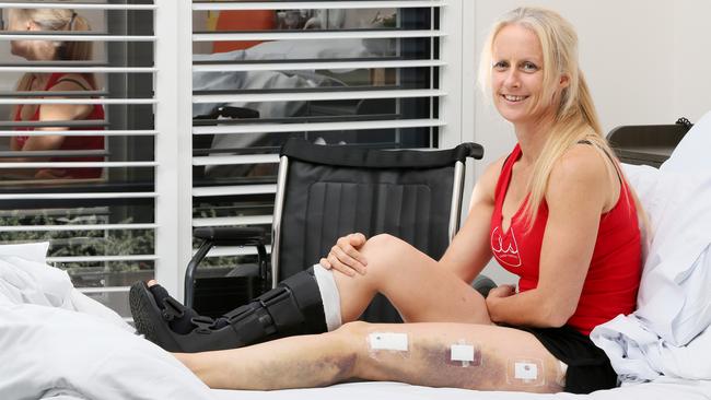 Probationary Constable Julieanne Garland who broke both legs when a tree fell on her during last month’s super storm in Sydney. Pictured at Brisbane Water Private Hospital recovering.