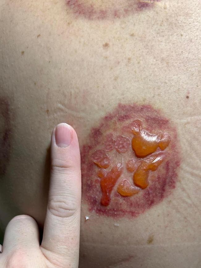 Pictures of blisters on a woman’s back after a cupping treatment. Picture – Facebook.