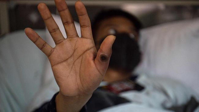 A patient showing his hand with a sore caused by an infection of the mpox virus. (Photo by Ernesto BENAVIDES / AFP)