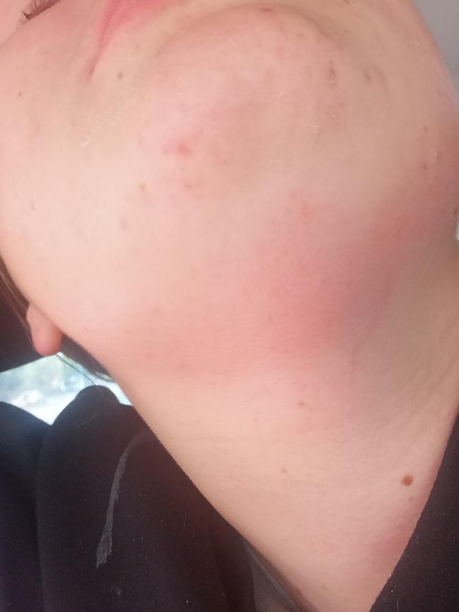 Red marks on Ms Gavin’s neck.