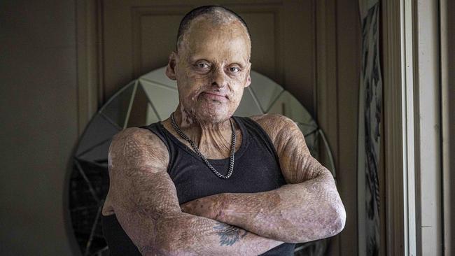 Burn victim Phil Payet is suing the state for withholding letters from him while in prison detailing threats of an assault which was made good on upon his release. Picture: Wayne Taylor