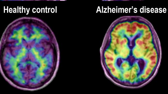 The scan on the left shows a healthy brain, in contrast to the scan on the right, which shows plaque build up.