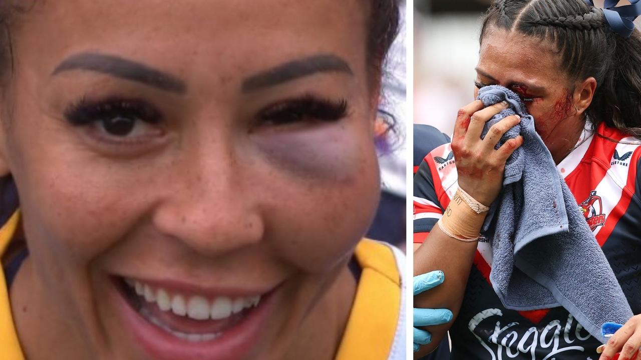 Therese Aiton had a beauty of a shiner and was loving it. Photo: Fox Sports and Getty Images