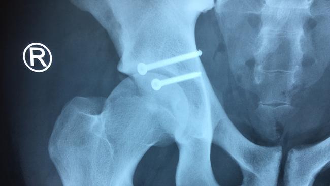 An X-ray showing where Gold Coast Suns player Sam Day had two screws inserted to reattach a piece of bone to his hip. Picture: Gold Coast Suns.