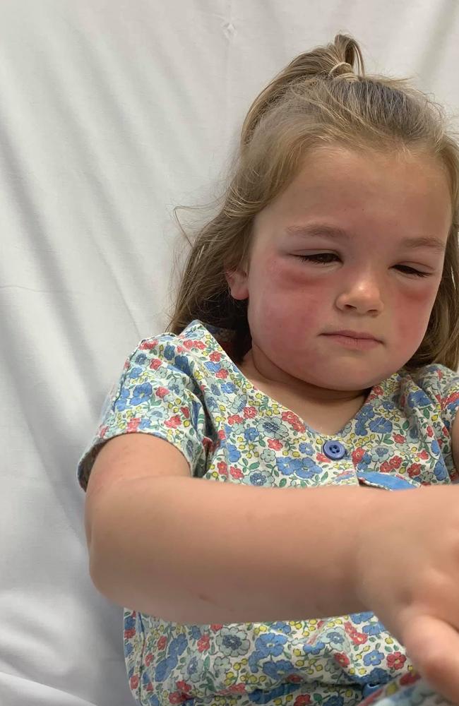 Girl suffers severe allergic reaction to caterpillar, prompting warning