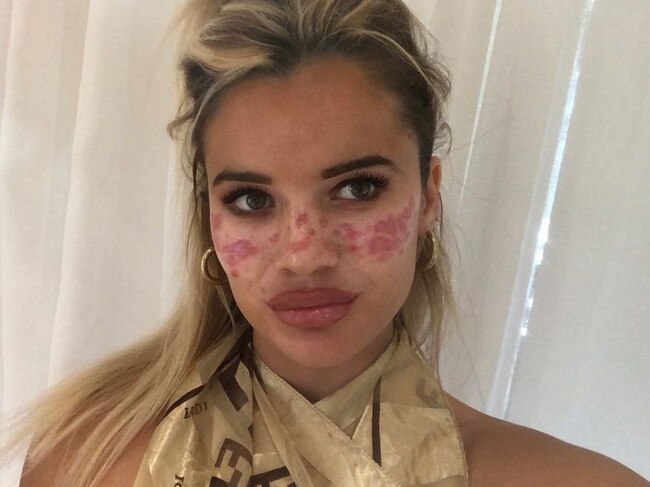 Tilly Whitfeld went viral with a Tik Tok DIY Freckle Hack that gave her scarring and vision loss. Picture: Instagram