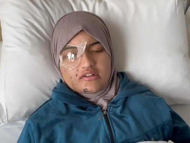 Australian Ranem Abu-Izneid has been blinded in one eye.