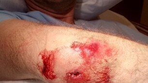 Cyclist's fractured elbow after being pushed off his bike on the Gold Coast. Supplied