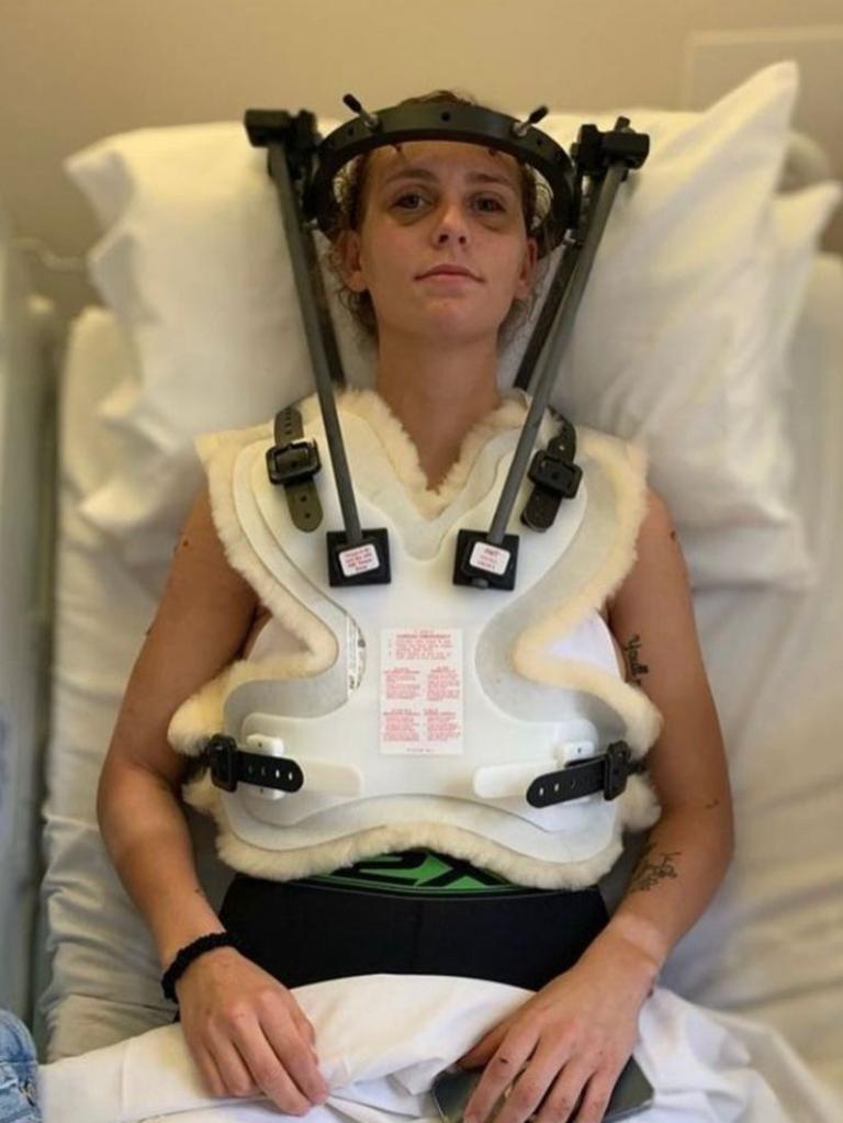 Rylee Foster had to wear a halo and was immobilised for nine months after a serious car crash. Photo Supplied.