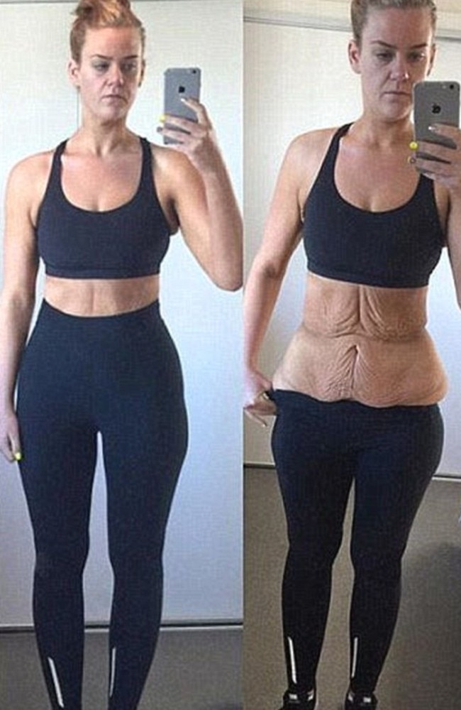 Simone Anderson Weight Loss Woman Shares Photo Of Amazing Body After Excess Skin Removal 4681