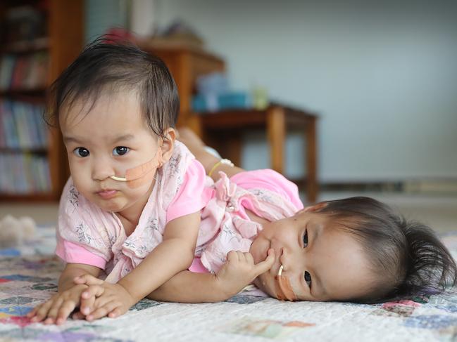 The Bhutanese conjoined twins Nima [left] and Dawa [right] before their surgery on Friday 9th Nov at the Royal Children's Hospital.  The girls are currently staying at the Children First Miracle Smiles Retreat in Kilmore. Picture: Alex Coppel