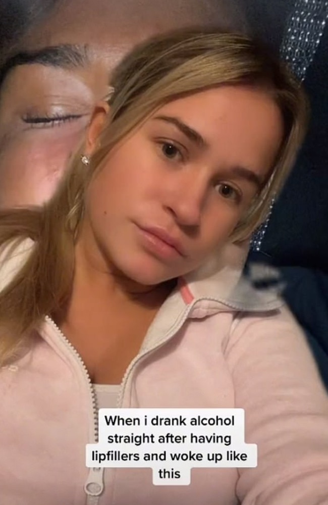 The TikToker, who goes by the name of Morgan Proudlock, said in a now viral clip, she didn’t ‘drink much’ but it was enough to cause extreme swelling. Picture: TikTok/mp1997x