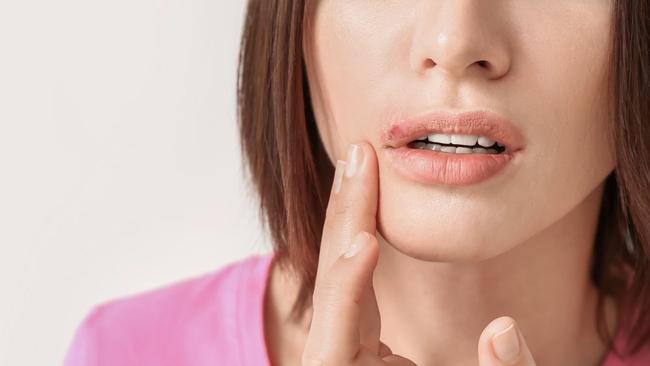 cold sore and link to disease