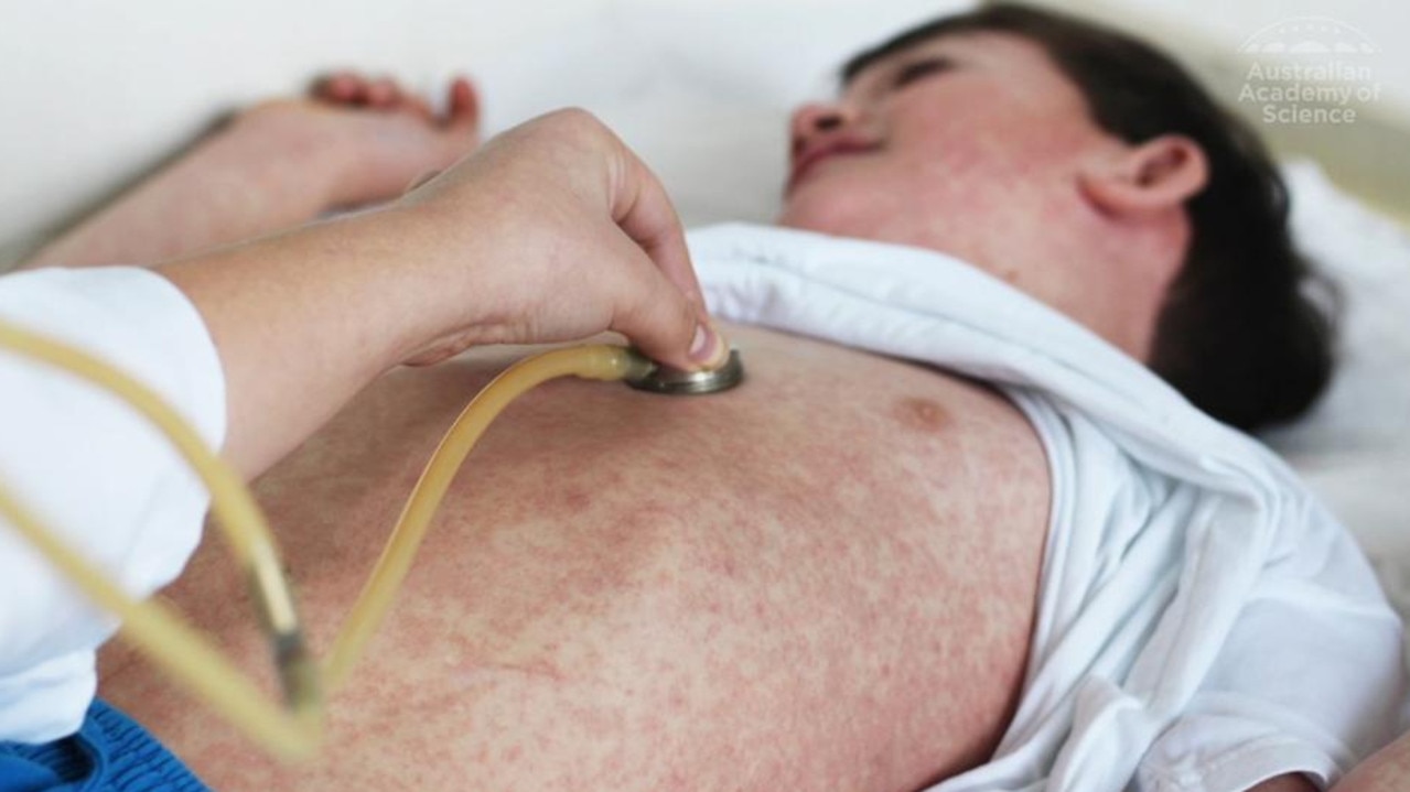 Measles causes rash and fever and can trigger serious health complications. Picture: Supplied