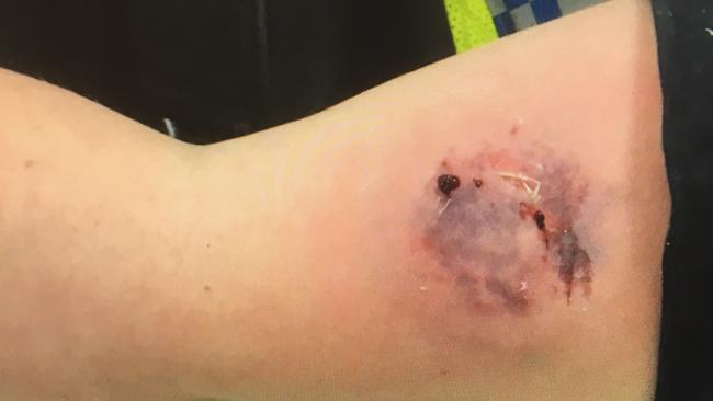 Rechelle McCartney’s scarred arm after she suffered a bite.