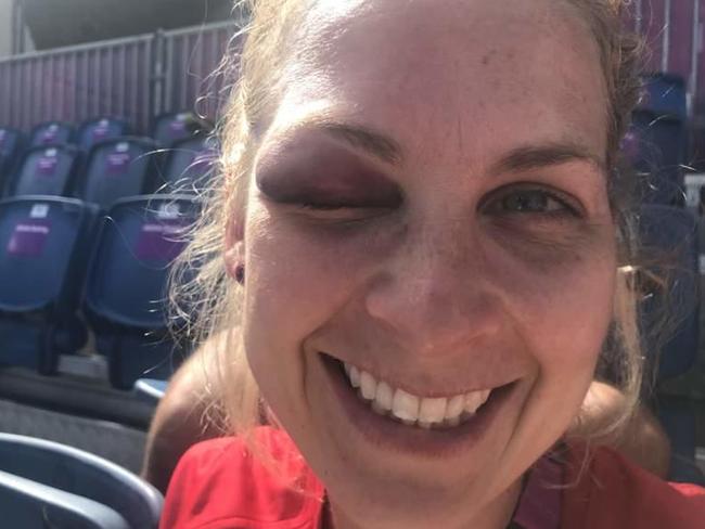 Leah Wilkinson is on track for gold in the, “Best shiner of the Games” event.