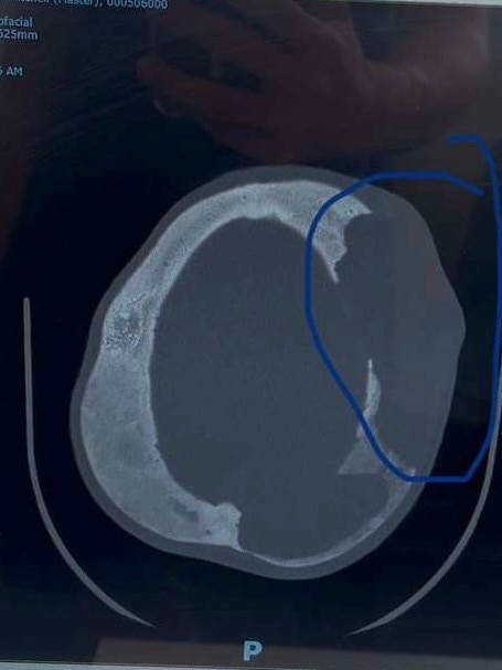 Will’s scans revealed multiple bone cyst in his skull. Picture: Supplied