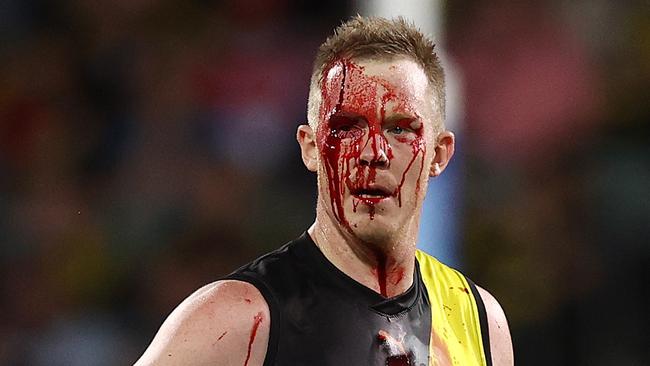 Jack Riewoldt comes off with the blood rule during the 1st qtr. Picture: Michael Klein