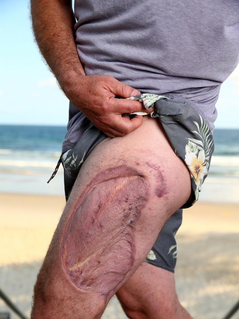 Edwardes with the scars left by a shark attack. PICTURE: Adam Head