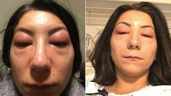 A Canadian woman is warning others about the potential dangers of eyelash extensions after developing a severe allergic reaction to the adhesive used. Picture: Isabelle Kun/Facebook