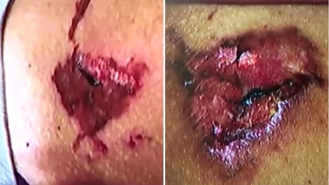 The second-degree burns on Olivia's thighs. Image: YouTube