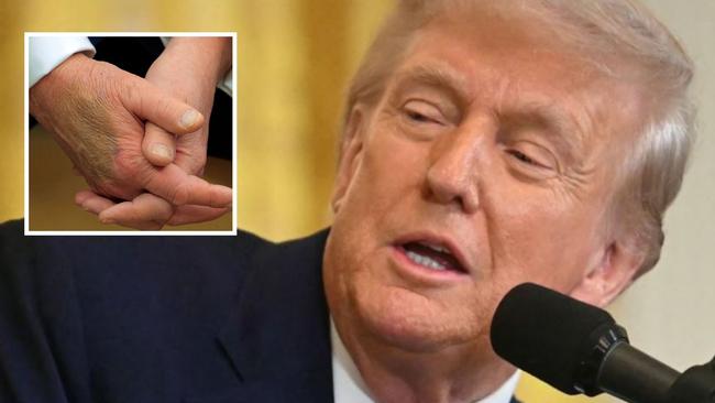 Speculation mounts about marks on Donald Trump's hand. Picture: Getty.