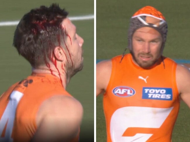 Toby Greene had his head cut open.