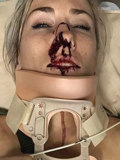 Caroline Buchanan posted photos of her 2017 accident on Instagram.