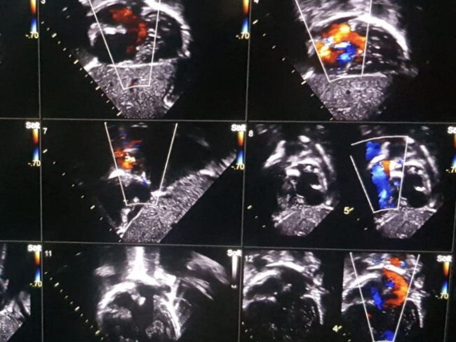 Joshua’s latest heart scan