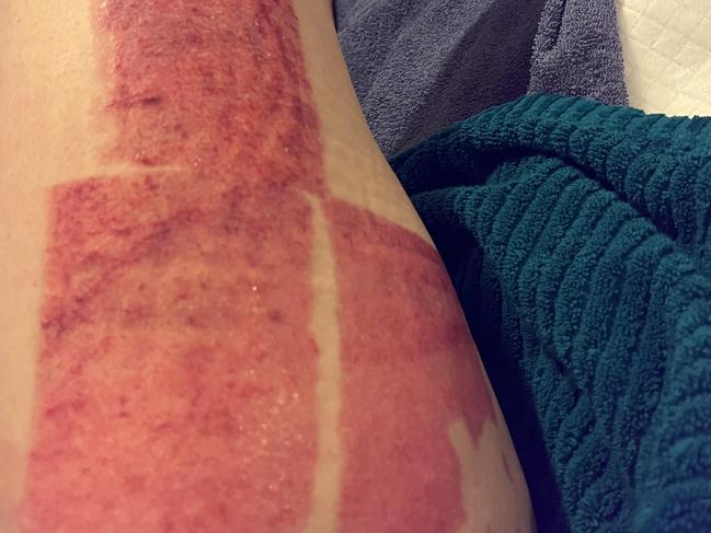 Madeline Sirianni, hot water bottle burn. Picture: Supplied