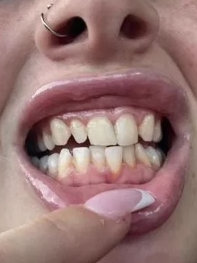 The teeth before the surgery. Picture: TikTok/@nikeishalouise