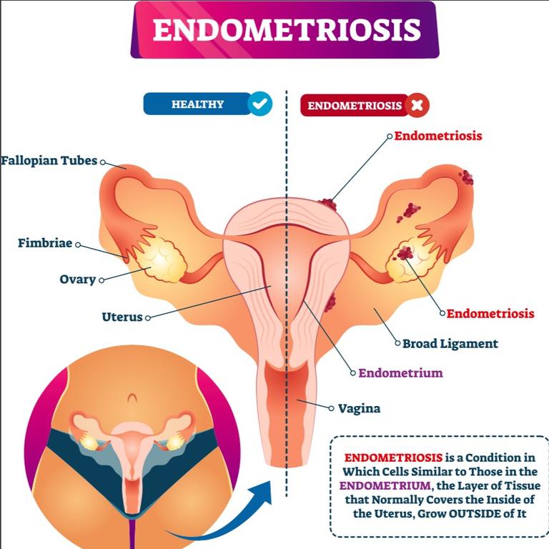 Millions of women around the world suffer from endometriosis. Picture: iStock