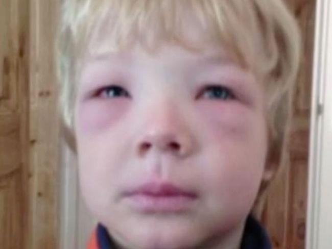 Food allergy affects one in 12 children in Australia. Picture: 7 News