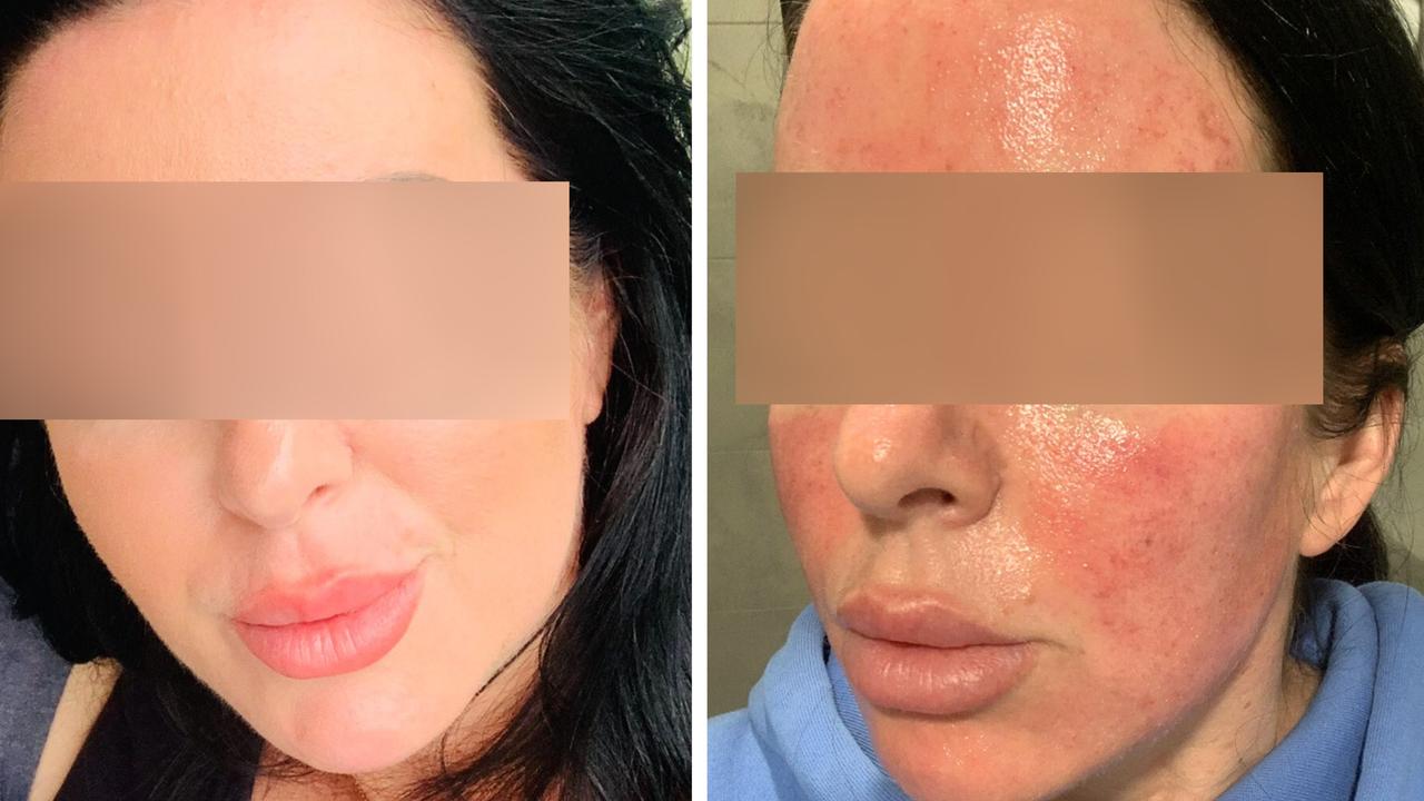 Sarah's skin needling turned into a horrific nightmare as the alarm is sounded over a lack of regulation in Australia. Picture: Supplied