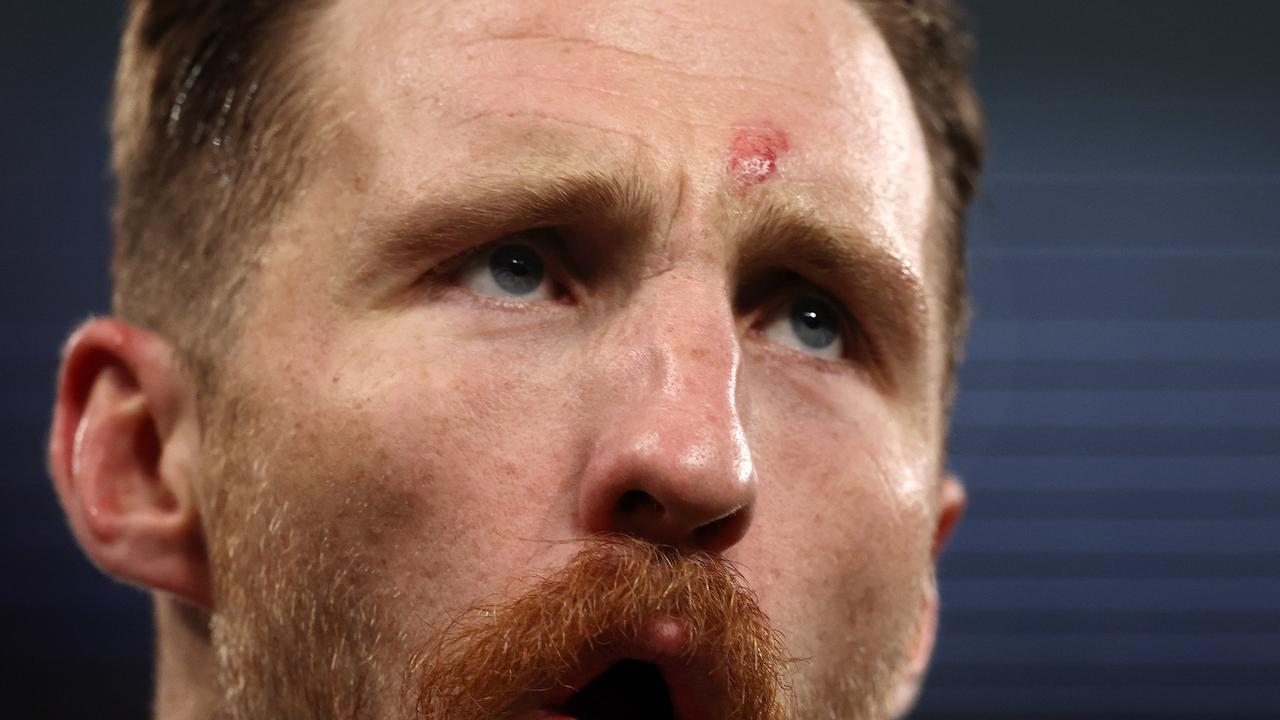 Zach Tuohy with a mark on his forehead from Bailey Smith’s headbutt. Picture: Michael Klein
