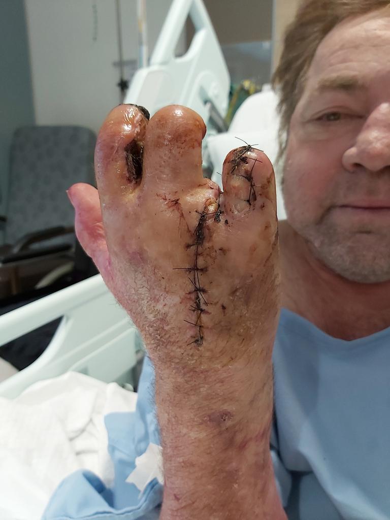 Tony Di Giovanni lost the fingers on his right hand after an infection acquired in hospital.