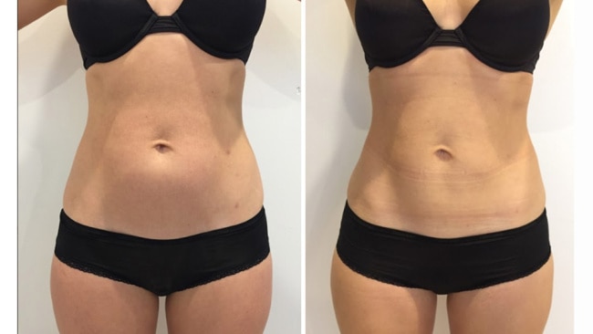 Does fat cavitation really work?