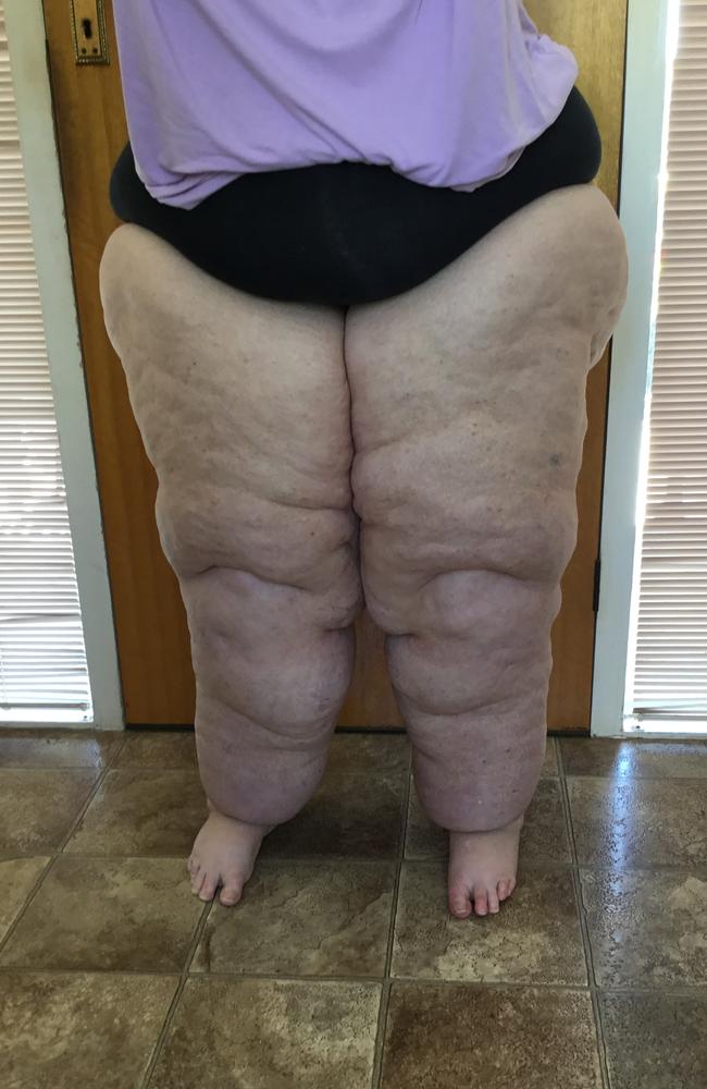 Sandra French says surgery for lipoedema has been ‘life changing’. Picture: Supplied.,