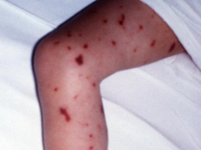 Meningococcal meningitis infection - rash. 28/2/99