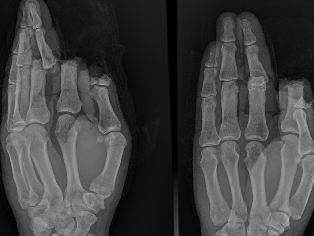 Whole of hand X-ray of Sydney Hospital patient who suffered an injury while using a circular saw. Picture: supplied