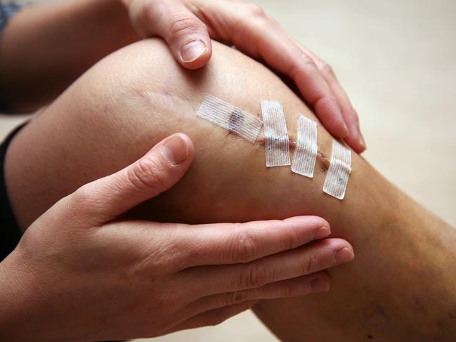 Silver products can exclude knee surgery Picture: istock